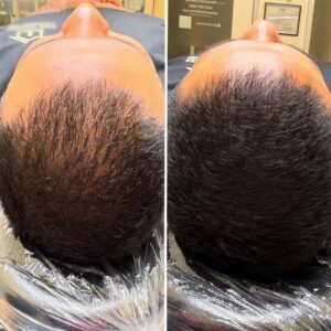 Before and After Hair Fiber Tattoo for Thinning Hair